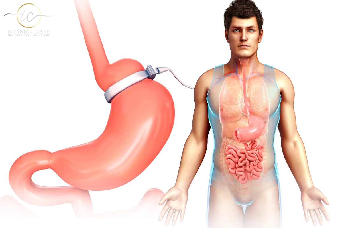 gastric-band-in-turkey Gastric Band in Turkey