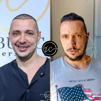 hair transplant before after istanbul-care