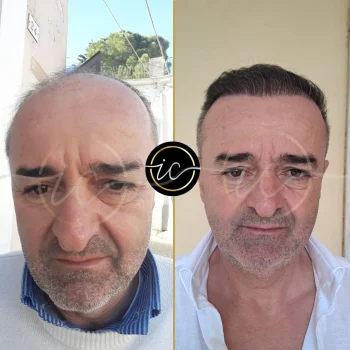before after images for hair transplant in turkey