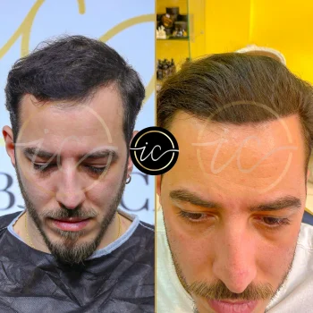 hair transplant before after istanbul