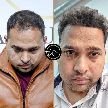 before after images for hair transplant in Istanbul